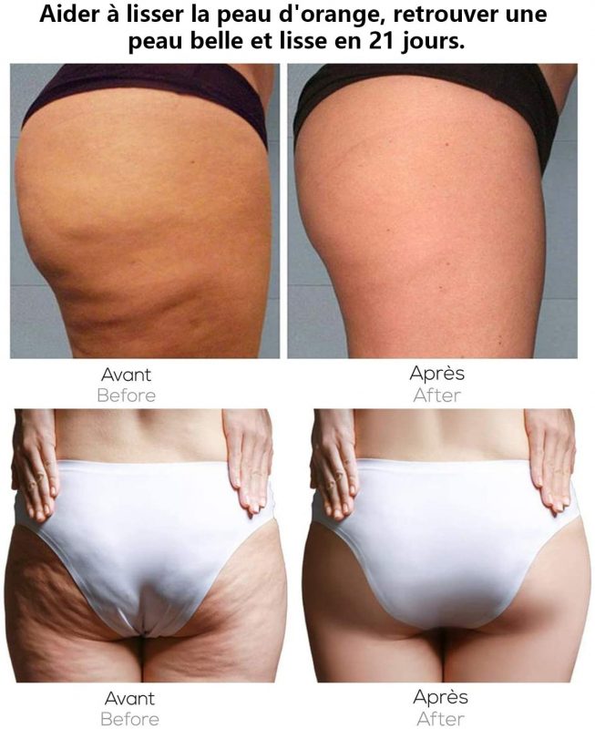 Représente une amélioration de la cellulite